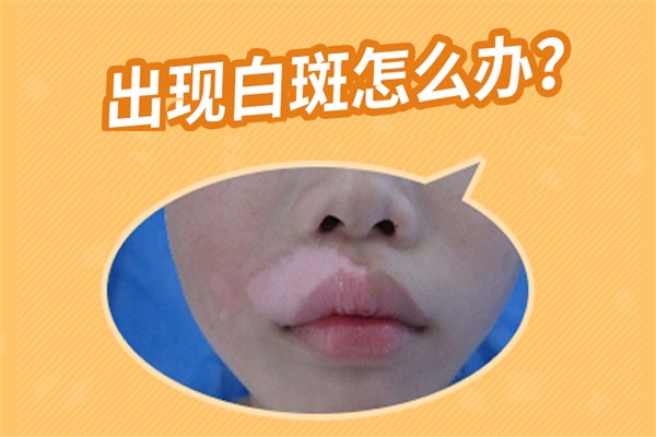 年紀比較小的孩子身上出現(xiàn)了白癜風要怎么辦?