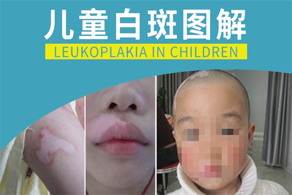 兒童身上出現了白癜風都會產生哪些癥狀?