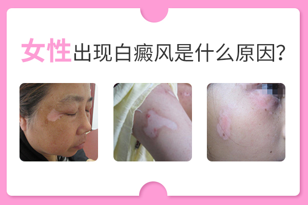 誘發(fā)女性長白癜風(fēng)的原因有哪些呢？