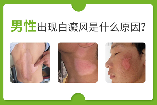 男性手上易長白癜風是怎么回事？