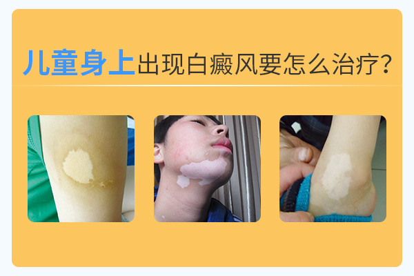 兒童治療白癜風(fēng)過程中要避開什么呢？