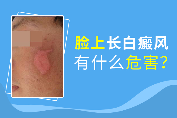 臉部白癜風(fēng)會給患者帶來什么傷害呢？