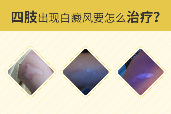 為什么手腳上的白癜風會比較難治呢？