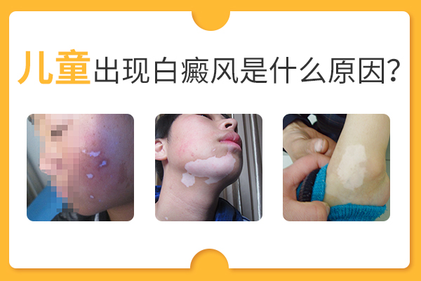 合肥兒童會因為什么原因而患上白癜風(fēng)呢？