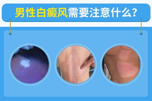 合肥男性確診得了白癜風(fēng)要怎么做才好呢?